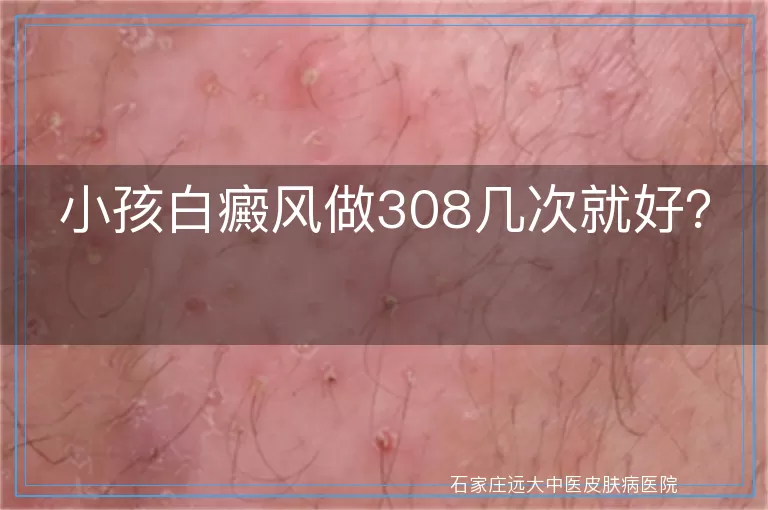 小孩白癜风做308几次就好？