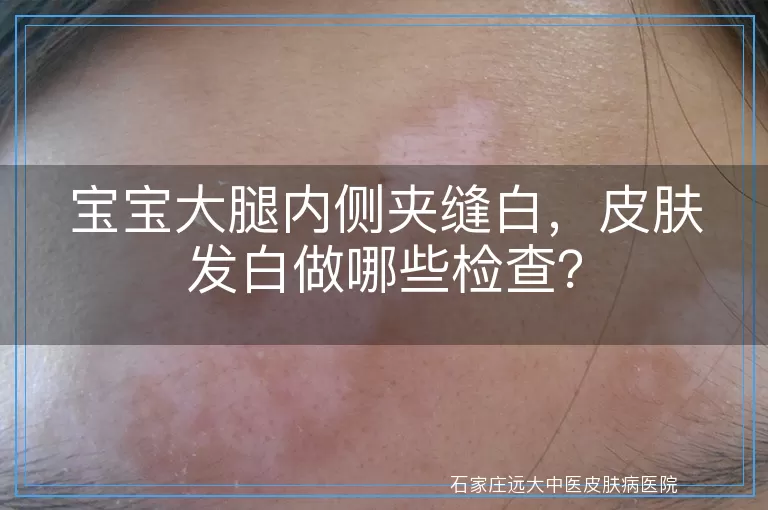 宝宝大腿内侧夹缝白，皮肤发白做哪些检查？