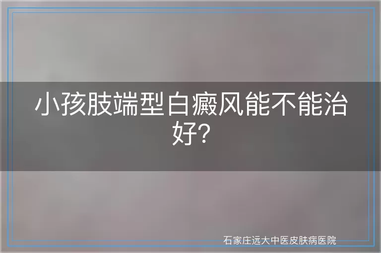 小孩肢端型白癜风能不能治好？