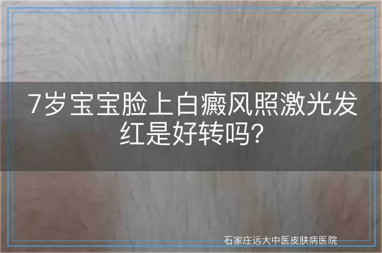 7岁宝宝脸上白癜风照激光发红是好转吗？