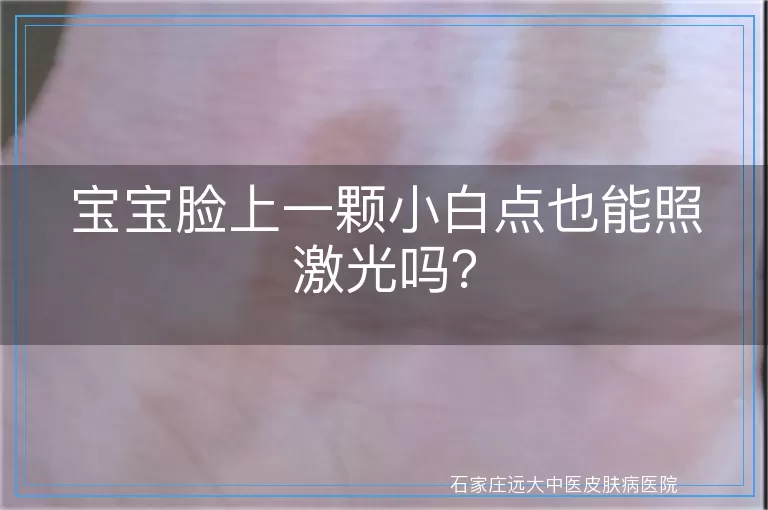 宝宝脸上一颗小白点也能照激光吗？