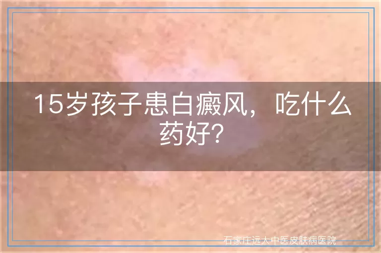 15岁孩子患白癜风，吃什么药好？