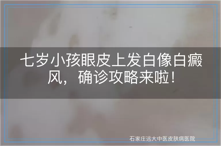 七岁小孩眼皮上发白像白癜风，确诊攻略来啦！