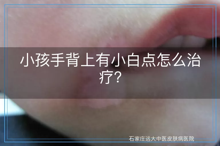 小孩手背上有小白点怎么治疗？