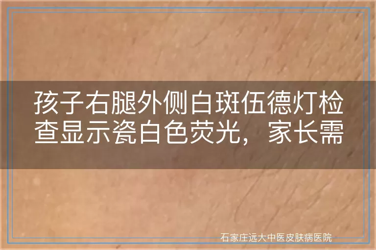 孩子右腿外侧白斑伍德灯检查显示瓷白色荧光，家长需警惕白癜风

<h2>一、发现白斑，及时就医是关键</h2>
<p>作为家长，一旦发现孩子右腿外侧出现白斑，心里肯定是既焦急又担心。白斑，这个看似简单的皮肤问题，实际上可能隐藏着多种疾病。而伍德灯检查，就是揭开这个谜团的重要工具。</p>

<h2>二、伍德灯检查，揭秘白斑真相</h2