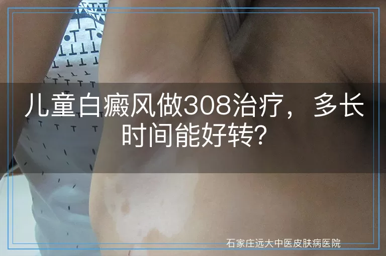 儿童白癜风做308治疗，多长时间能好转？