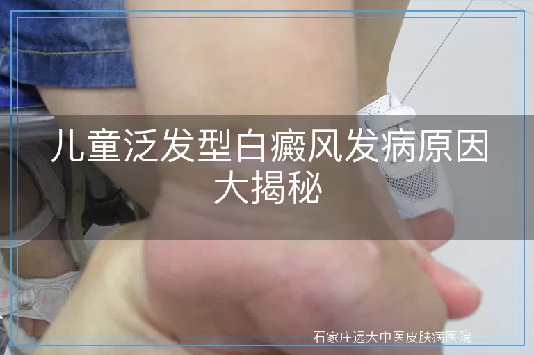 儿童泛发型白癜风发病原因大揭秘