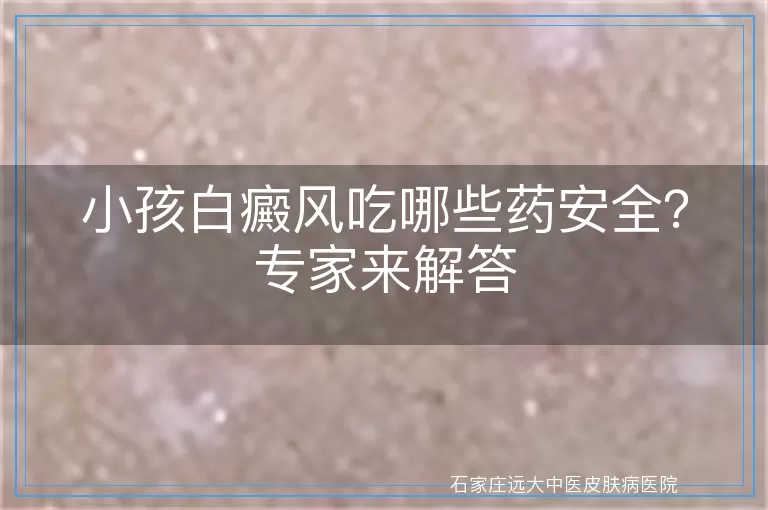 小孩白癜风吃哪些药安全？专家来解答