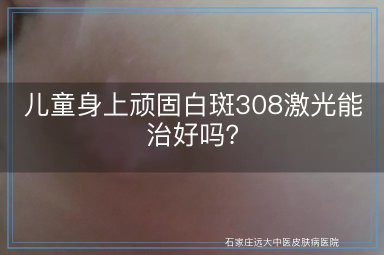 儿童身上顽固白斑308激光能治好吗？