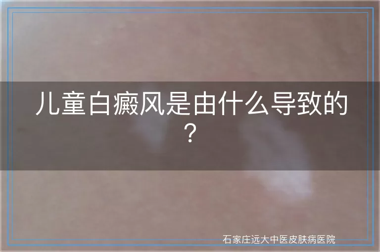 儿童白癜风是由什么导致的？