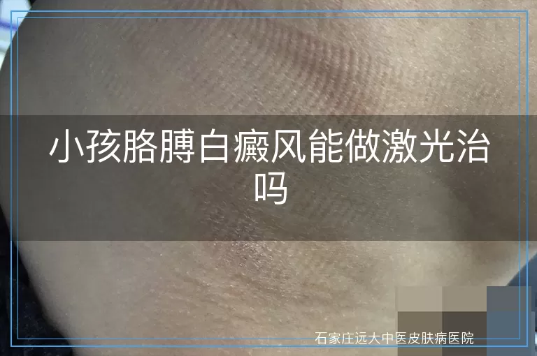 小孩胳膊白癜风能做激光治吗