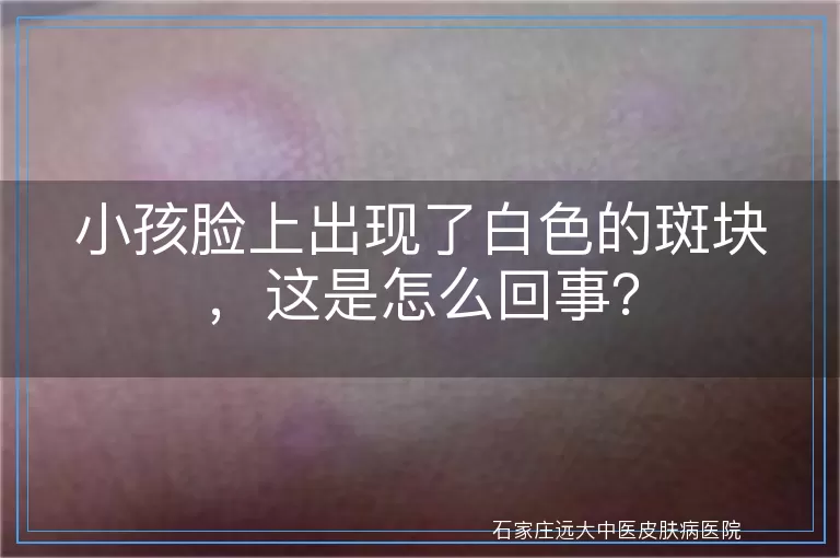 小孩脸上出现了白色的斑块，这是怎么回事？