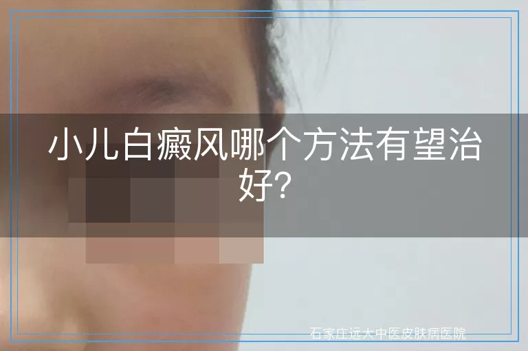 小儿白癜风哪个方法有望治好？