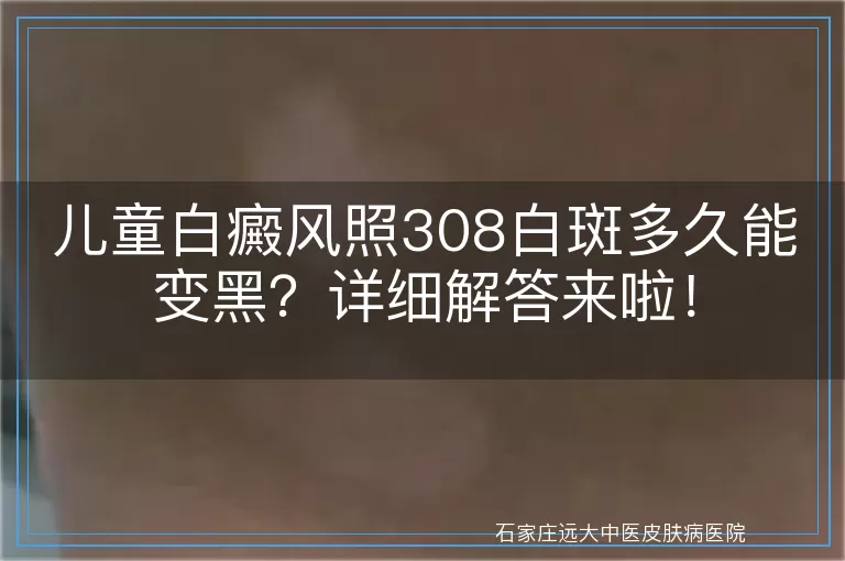 儿童白癜风照308白斑多久能变黑？详细解答来啦！