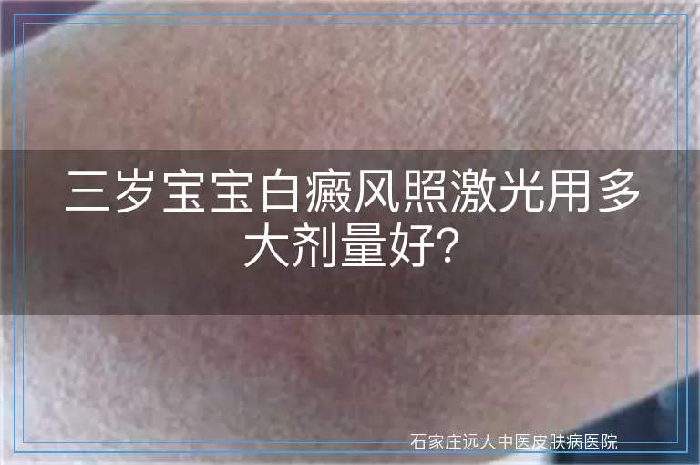 三岁宝宝白癜风照激光用多大剂量好？