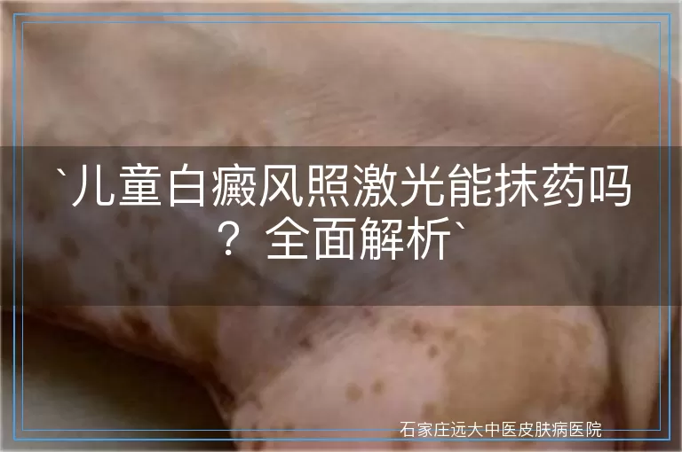 儿童白癜风照激光能抹药吗？全面解析