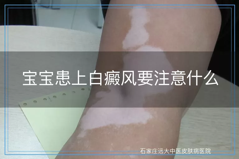 宝宝患上白癜风要注意什么