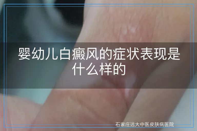 婴幼儿白癜风的症状表现是什么样的