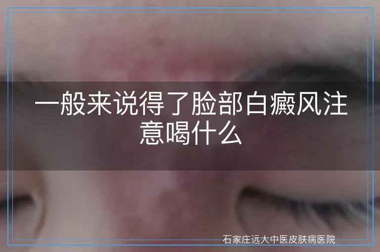 一般来说得了脸部白癜风注意喝什么