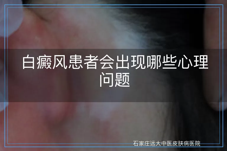 白癜风患者会出现哪些心理问题