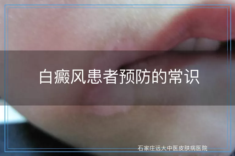 白癜风患者预防的常识