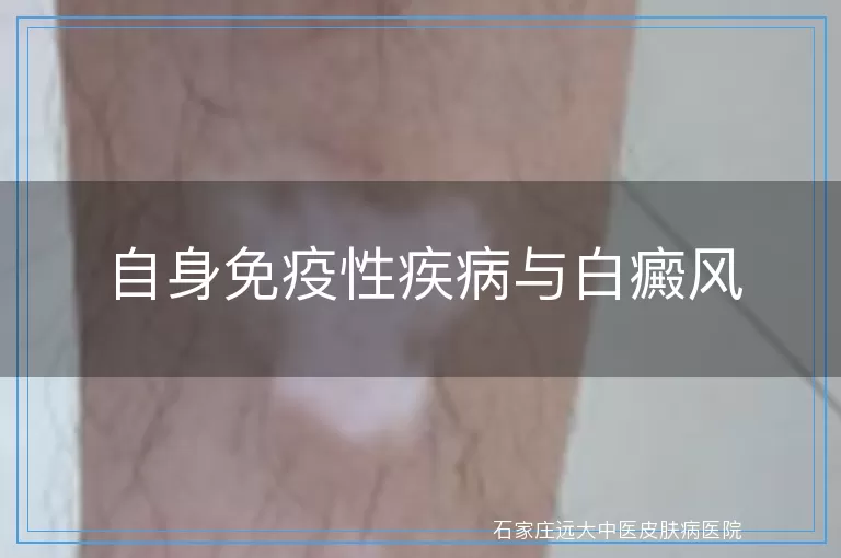 自身免疫性疾病与白癜风