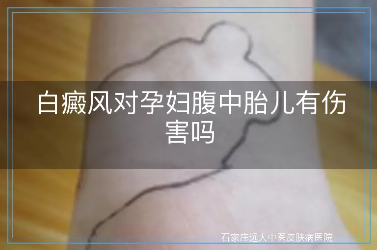 白癜风对孕妇腹中胎儿有伤害吗