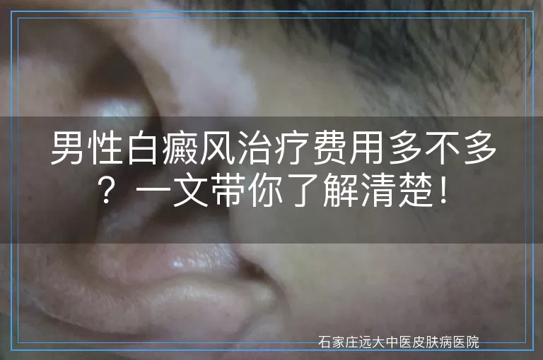 男性白癜风治疗费用多不多？一文带你了解清楚！