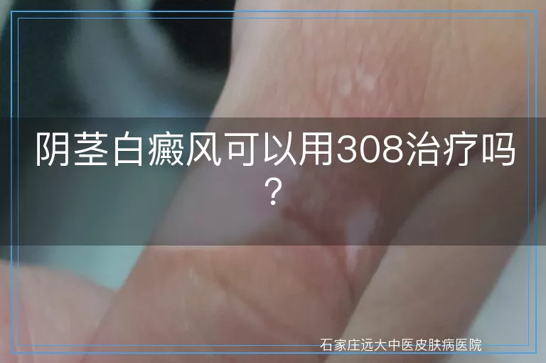 阴茎白癜风可以用308治疗吗？