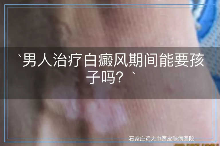 `男人治疗白癜风期间能要孩子吗？`