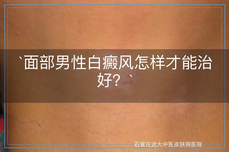 `面部男性白癜风怎样才能治好？`