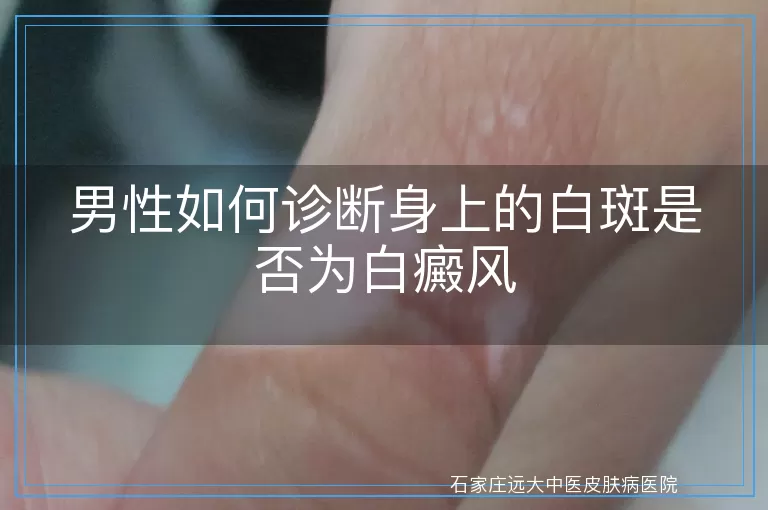 男性如何诊断身上的白斑是否为白癜风