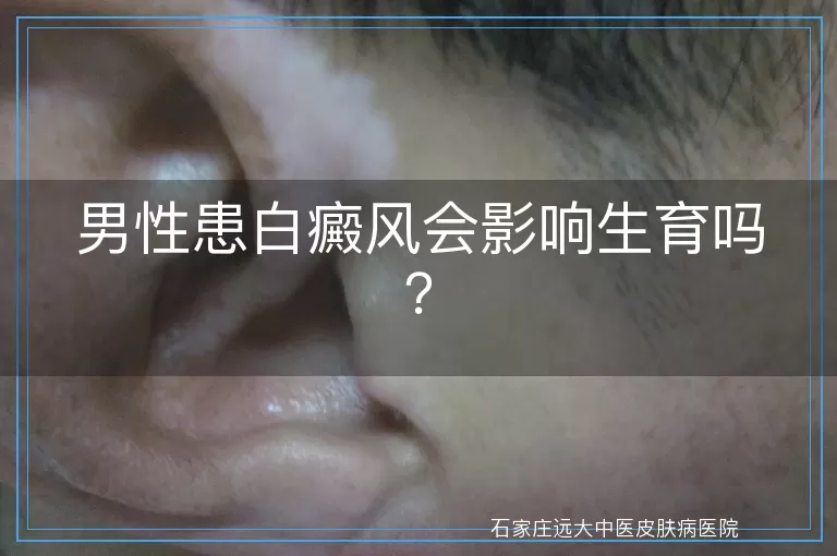 男性患白癜风会影响生育吗？