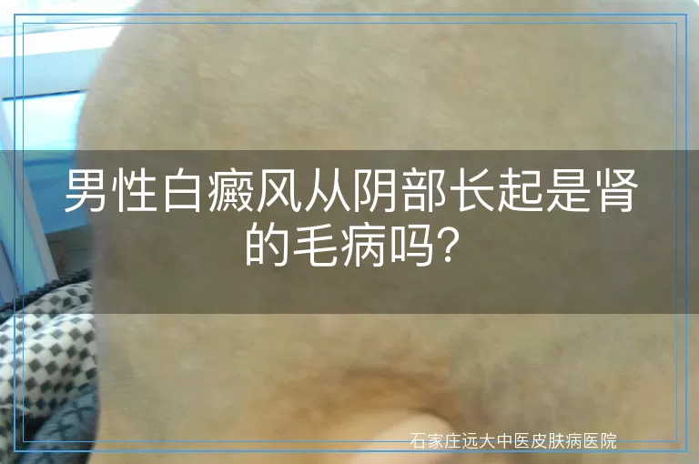 男性白癜风从阴部长起是肾的毛病吗？