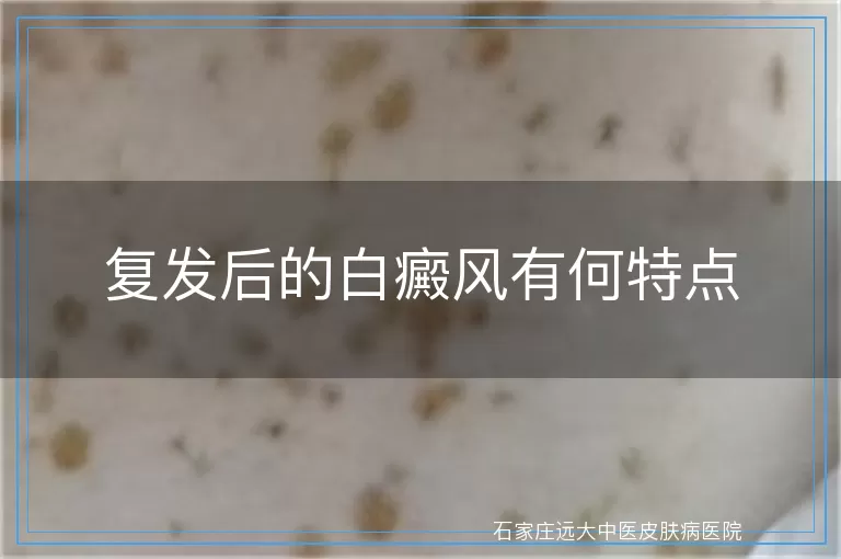 复发后的白癜风有何特点