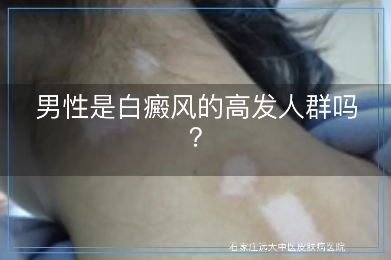 男性是白癜风的高发人群吗？