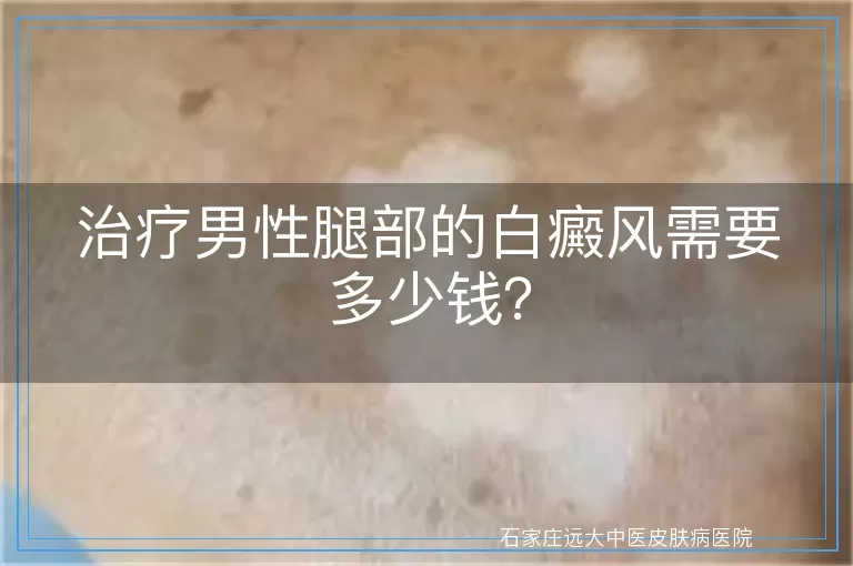 治疗男性腿部的白癜风需要多少钱？