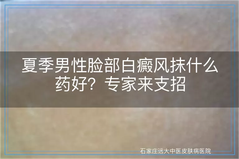 夏季男性脸部白癜风抹什么药好？专家来支招