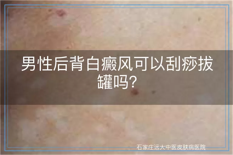 男性后背白癜风可以刮痧拔罐吗？