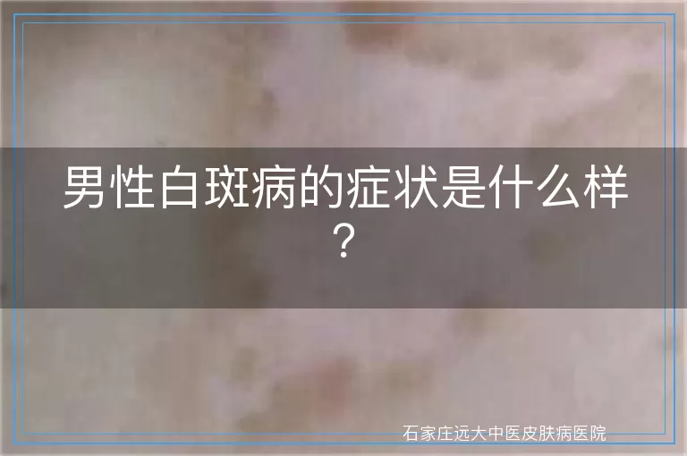 男性白斑病的症状是什么样？