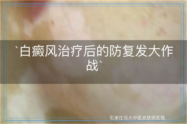 白癜风治疗后的防复发大作战