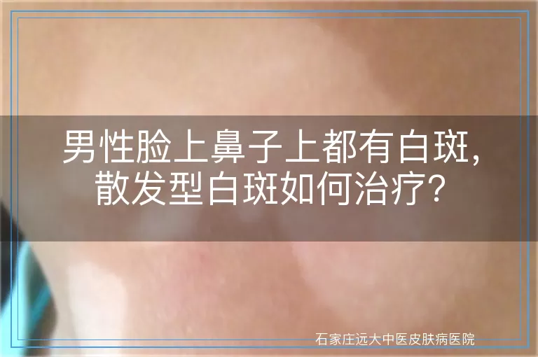 男性脸上鼻子上都有白斑，散发型白斑如何治疗？