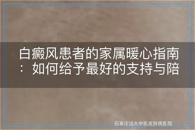 白癜风患者的家属暖心指南：如何给予最好的支持与陪伴