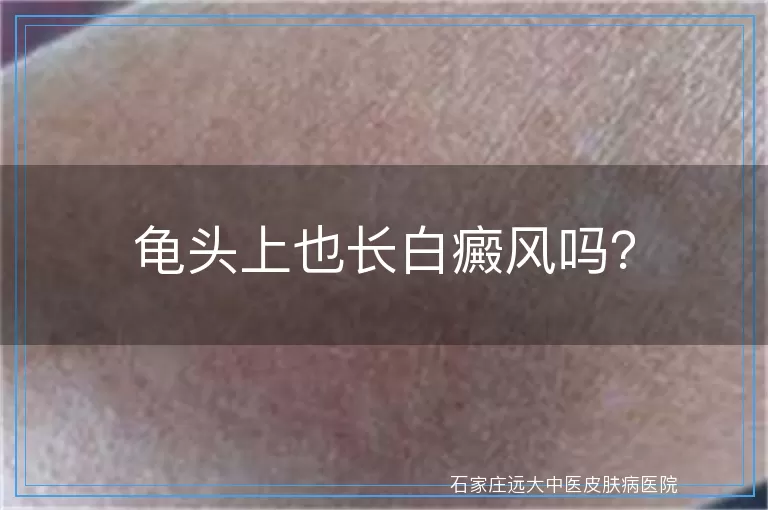 龟头上也长白癜风吗？