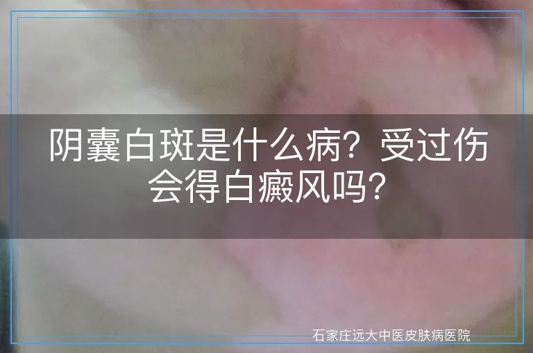 阴囊白斑是什么病？受过伤会得白癜风吗？