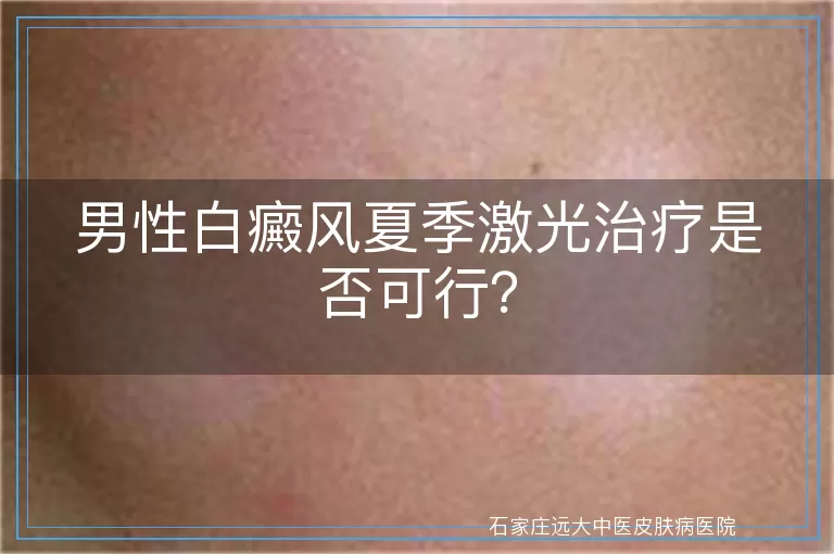 男性白癜风夏季激光治疗是否可行？