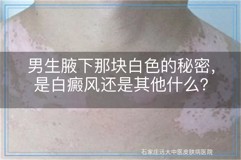 男生腋下那块白色的秘密，是白癜风还是其他什么？