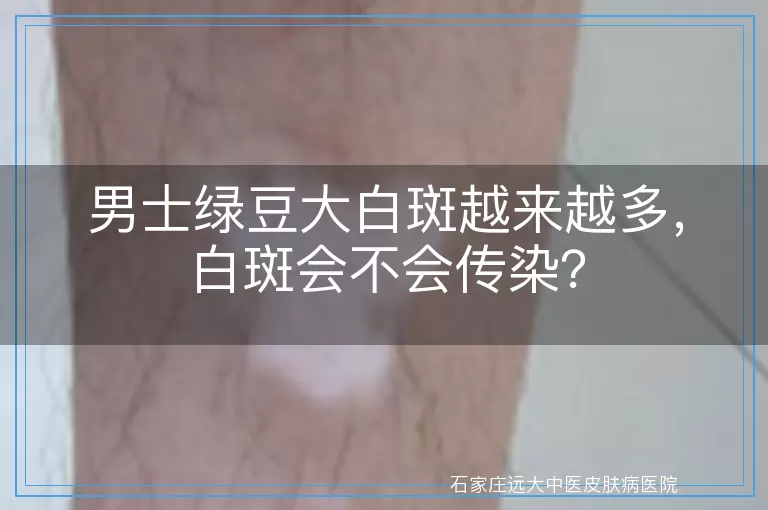 男士绿豆大白斑越来越多，白斑会不会传染？