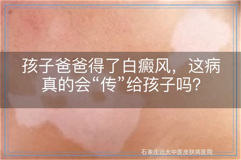 孩子爸爸得了白癜风，这病真的会“传”给孩子吗？