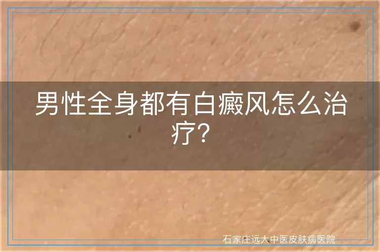 男性全身都有白癜风怎么治疗？